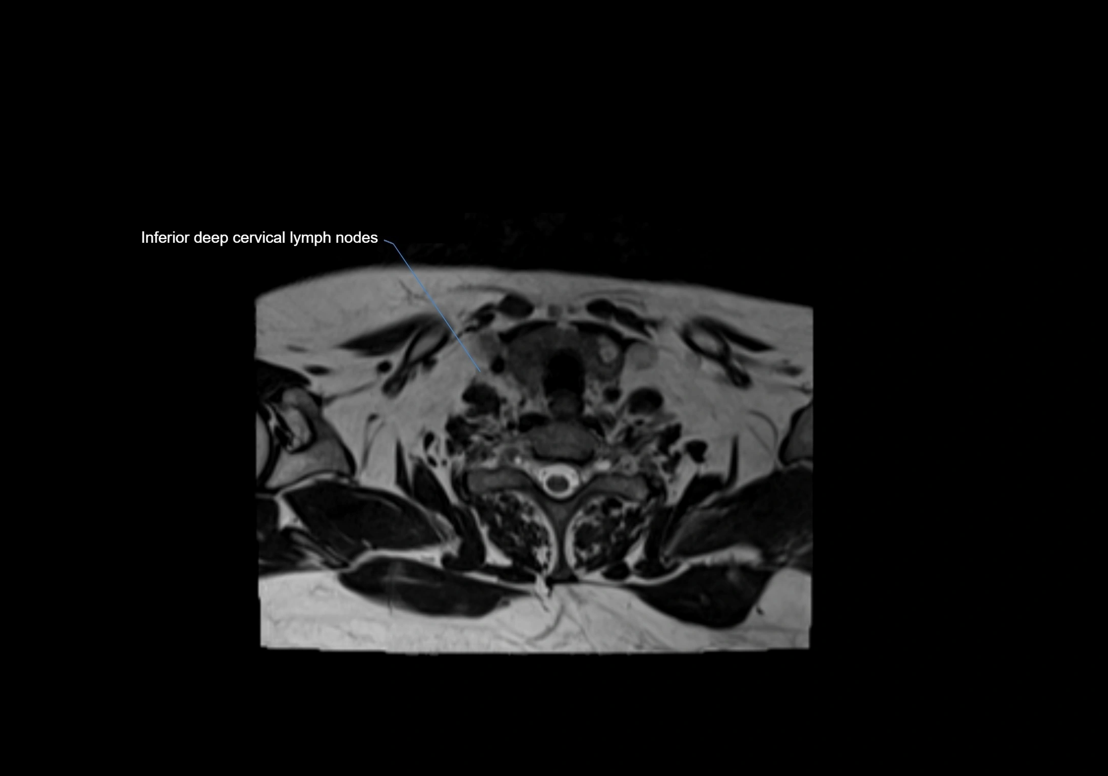 Neck axial  lymph node cross sectional MRI anatomy 3T MRI  image-img-00001-00085.webp